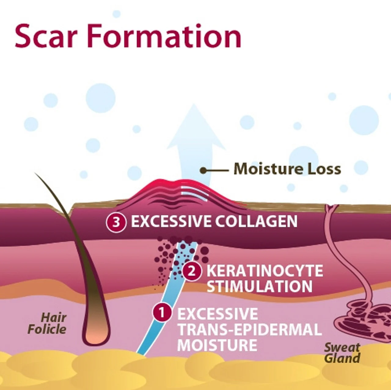 Epi-Derm Clear Gel Sheeting - Areopexy - Image 6